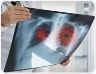 Study suggests CT imaging with automated AI system predicts EGFR genotype, identifying mutation status cost-effectively and non-invasively