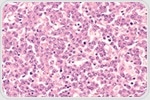 Scientists uncover four proteins that govern the identity of anaplastic large cell lymphoma
