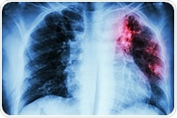 Unraveling gene regulation's role in pulmonary fibrosis
