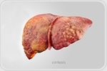 UMH research reveals key role of immune protein in liver cirrhosis