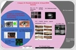 AI-Powered Solutions for Personalized Therapeutic Interventions in Dry Eye Disease