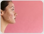 Antioxidant-rich diets linked to better life quality in young women with acne
