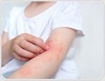 Study investigates the potential effects of neonatal vitamin D on eczema up to adulthood