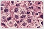 Novel immunotherapy shows promise for high-risk sarcomas: HEROS 2.0 trial results published