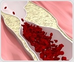 Atherosclerosis burden and progression predict all-cause mortality