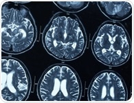 Transposable elements found to be dysregulated in Alzheimer's brains, revealing potential targets for therapy