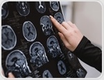 Researchers uncover distinct cell vulnerabilities in Alzheimer’s progression with novel multiomics approach