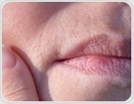 Researchers identify shared genetic variants between testosterone traits and PCOS