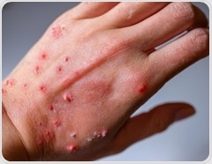 A review of clinical features, diagnosis, and management of Mpox