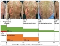 Researchers uncover the potential of JAK inhibitors to treat life-threatening skin disease