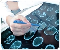 Fluorescein angiography improves diagnostic accuracy in carpal tunnel surgery