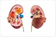 Diabetes drug semaglutide proves beneficial for patients with chronic kidney damage and obesity