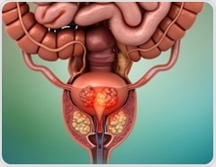 AI-powered MRI predicts outcomes in prostate cancer