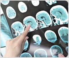 New calculator predicts epilepsy risk after venous stroke