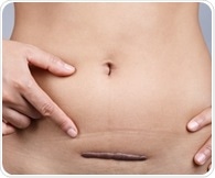 New guidelines emphasize non-surgical treatments for uterine fibroids