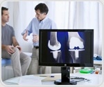 Knee replacement surgery outcomes improve with native alignment approach