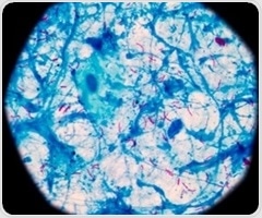 Study finds high risk of pediatric tuberculosis in high-burden areas