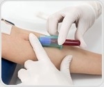Innovative blood test shows potential to replace spinal tap for Alzheimer's diagnosis