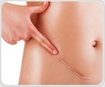 Pitt study uncovers a novel trigger of deadly form of ovarian cancer