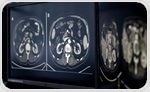 AI Analysis of CT Scans Reveals Early Kidney Damage from Cancer Treatment