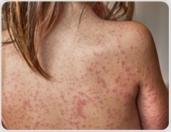 Why measles is making a comeback despite available vaccines