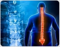 Lipid accumulation levels reveal hidden osteoporosis risk