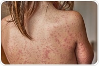 Why Measles Is Making a Comeback Despite Available Vaccines