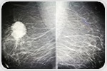 Radiomics reveals breast texture patterns associated with cancer risk