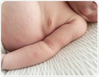 Japanese study shows c-sections do not raise allergy risk in children