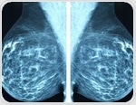AI spots future breast cancer risk in mammograms years before diagnosis
