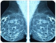AI spots future breast cancer risk in mammograms years before diagnosis