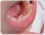 Can smoking while pregnant harm your child’s teeth? New research suggests yes