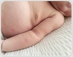 Japanese study shows c-sections do not raise allergy risk in children