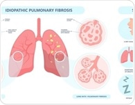 AI-designed drug shows early promise for lung fibrosis patients in clinical trial