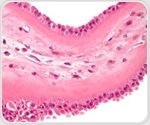Lung cells in COPD patients show higher levels of soot-like carbon deposits
