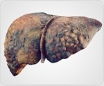New intercellular network found to drive liver fibrosis progression