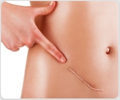 Mayo Clinic researchers discover how ovarian cancer may begin