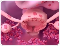 Endometriosis linked to higher odds of autoimmune conditions