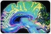 Gene therapy shows promise for reducing stroke risk in patients with sickle cell disease