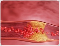 Heart scan study reveals low-fiber diets drive dangerous heart plaques