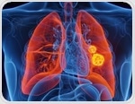 IL-6 and CRP offer limited boost for predicting infections after lung cancer surgery