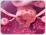 Endometriosis linked to higher odds of autoimmune conditions