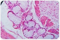 Organ chip technology accurately predicts chemotherapy response in esophageal adenocarcinoma patients