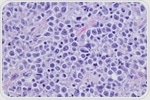 New Study Reveals Varied CAR T-Cell Therapy Benefits in Large B-Cell Lymphoma