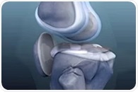 AI-enabled piezoelectric wearable device offers accurate and low-cost joint health tracking