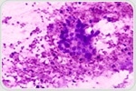 New TB drugs show promise with fewer side effects than linezolid