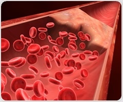 Chronic venous insufficiency linked to increased cardiovascular disease and mortality risk