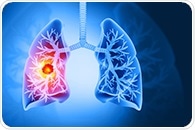 Bispecific antibodies offer new hope for resistant NSCLC patients
