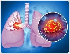 Allergies linked to lower lung cancer risk, new study finds