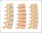 Safeguarding your spinal health
